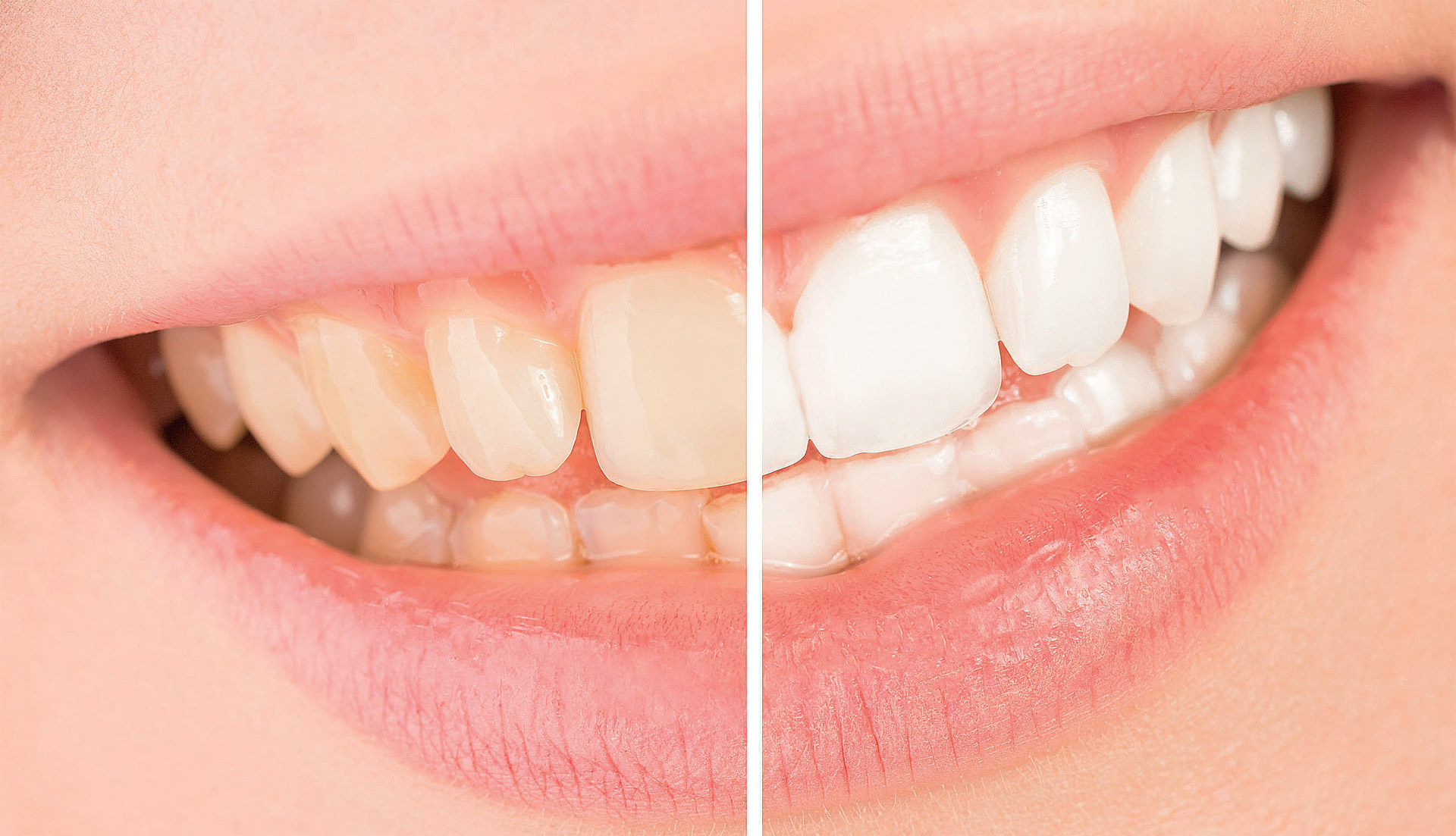 Diş Beyazlatma İşlemi