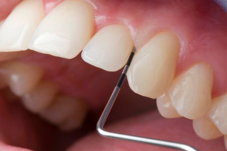 Muş diş eti tedavisi